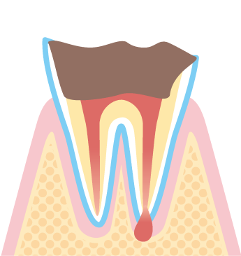 虫歯の進行ｃ4